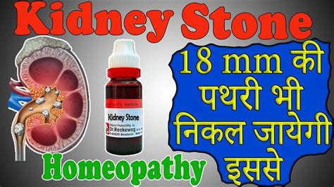 homeopathic medication for kidney stones